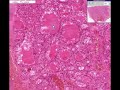 histopathology thyroid graves disease