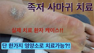 질환 리뷰 #25: 족저 사마귀 치료!! 단 한가지 영양소로 가능할까? #기능의학, #비타민