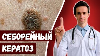 Себорейный кератоз 🧓 Что это и как лечить?