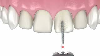 Emax Laminate Veneers