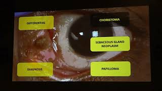 AIOCMT3 2024   GP44 topic   Dr  Subhav Pershad To report a rare presentation of choristoma as a caru