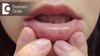 What causes black pigmentations in Oral Cavity?-Dr. Ajaz Pasha K M