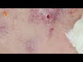 07.10.2019 watch full screen of acne extraction 44 ผ่าตัดซีสต์