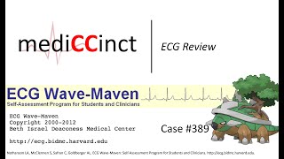 Right/Left Arm Electrode (Lead) Reversal (ECG Wave-Maven) Case #389