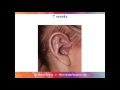 porous implant ear reconstruction for microtia