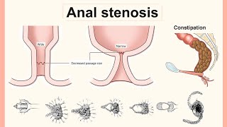 anal stenosis