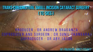 Trans conjunctival small incision cataract surgery-an elegant surgery