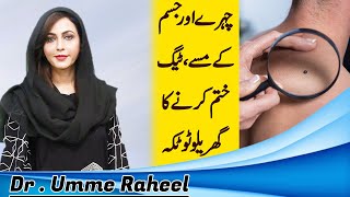 Amazing Way to Remove Skin Tags || Moles || Warts | Dr. Umme Raheel