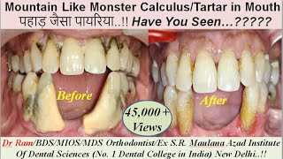 Giant Tartar Scaling/पहाड़ जैसा पायरिया/Monster Calculus removal. Treatment of Tartar/Calculus.