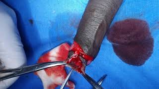 Chronic Balanoposthitis-Phimosis: Circumcision