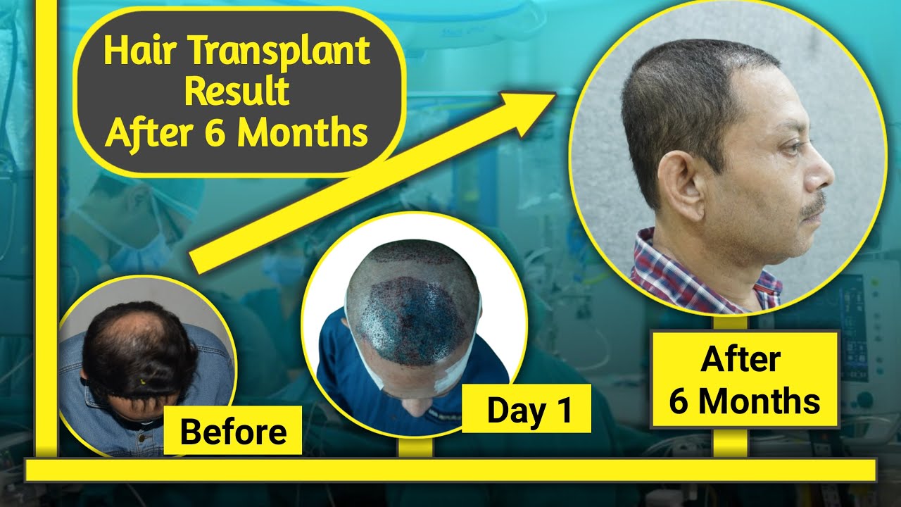 Hair Transplant Result After 6 Month || Cheapest Hair Transplant In ...