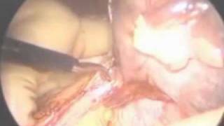 Large Spleens: The Hand-Assisted Videolaparoscopic Splenectomy Option