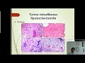 sesión anatomopatológica tumor mixofibroso lipoesclerosante