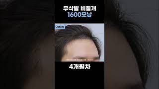 무삭발비절개 1600모낭｜모발이식｜헤어라인교정｜두피문신｜다나성형외과DANA #두피문신 #모발이식 #탈모치료