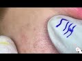 this what your remove blackheads should popping 87108