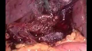 A complicated case of laparoscopic cholecystectomy