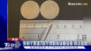 魚刺卡食道3個月!微創術後難痊癒 無法進食｜TVBS新聞