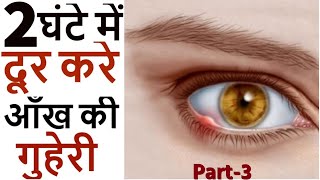 आँख की गुहेरी का इलाज | आंख की गुहेरी कैसे ठीक होती है? आंख में बिलनी हो जाए तो क्या करें? Stye