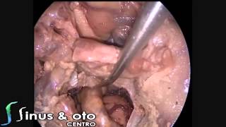 Endoscopic Skull Base Dissection + Draf 3 Approach