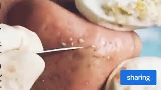 Acne nose |04 pickel ausdrücken Spa Zits blackheads pimple extraction new video 2025 Satisfying