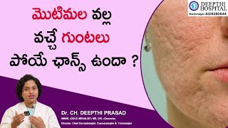 మొటిమల వల్ల వచ్చే గుంటలు పోయే ఛాన్స్ ఉందా ? | Dr Deepthi Prasad | Dermatologist | Karimnagar