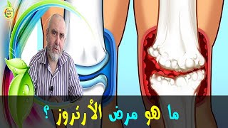 الأرتروز... مرض مزمن ينخر أجساد الشباب   -   الدكتور كريم العابد العلوي   -