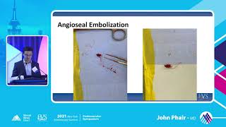 Complications and Bailouts Acute Vessel Closure Case - John Phair, MD