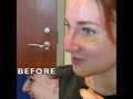 New Nose Reveal   Rhinoplasty Cast Removal