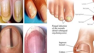 Nail Symptoms and What It Means for Your Health!