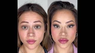 Botox Before + 2 Weeks After | Beauty By Afrooz