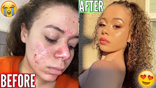 HOW I CLEARED MY SKIN IN A MONTH | Krazyrayray