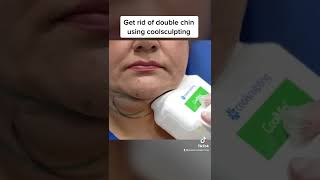 Doublechin removal using coolsculpting #shorts