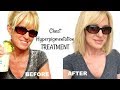 Get RID Of Chest HYPERPIGMENTATION & Sun Damage! Get RID Of Chest HYPERPIGMENTATION & Sun Damage!
