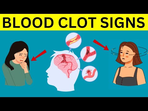 Never Ignore These Signs Of Blood Clot || #BloodClotSymptoms - YouTube