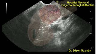 EUS in the diagnosis of HYPOVASCULAR PANCREATIC NEUROENDOCRINE TUMOUR