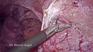 laparoscopic vaginoplasty in MRKH: Davydov's vaginoplasty