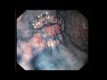 Intramucosal gastric cancer in gastric body ulcer