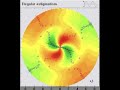 Visual rehab of cataract with corneal scar with  toric IOL implantation:diagnostics and calculations