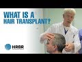 What is a hair transplant? - Hair Restoration Blackrock