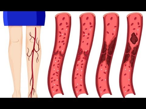 Natural Blood Thinners that Prevent Blood Clots Natural Blood Thinners that Prevent Blood Clots