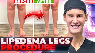 Abnormal FAT deposits? Expert tips about LIPEDEMA