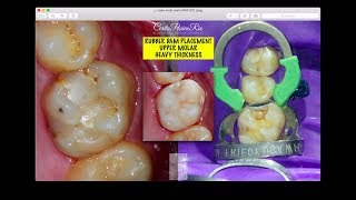 rubber dam placement maxillary molar multiple teeth isolation w14a hu friedy maxidam revoden