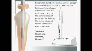 elementsfree Obturation System