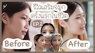 EP.2 รีวิวศัลยกรรมจมูก บอกหมด ทำที่ไหน ราคาเท่าไหร่ เจ็บมั้ย 👃🏻❗️  | Cherlynlychee