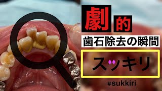 【閲覧注意/口腔崩壊】牡蠣化した歯石除去スッキリ歯科治療 Oyster-like tartar 歯医者 dentistry ASMR remove heavy tartar 日プ2 INI