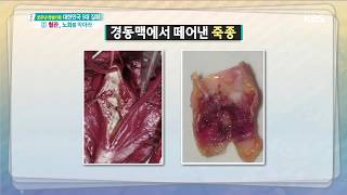 무엇이든 물어보세요 - 혈관 속 기름때와 찌꺼기가 혈관을 좁아지게 한다?! 20180904