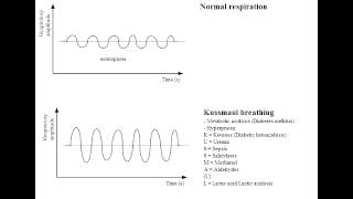 Kussmaul Breathing (Diabetic Ketoacidosis)