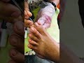 Ingrown toenail and impacted Toenail Relief and prevention pedicure tutorial💅🏼