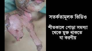 শীতকালে পোড়া সমস্যা থেকে মুক্ত থাকতে করণীয় কি ? Burn Problem in Bangladesh