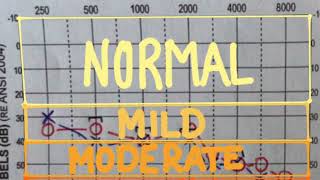 Degrees of hearing loss